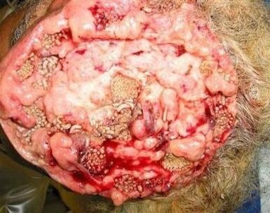 parasites dans le cerveau humain