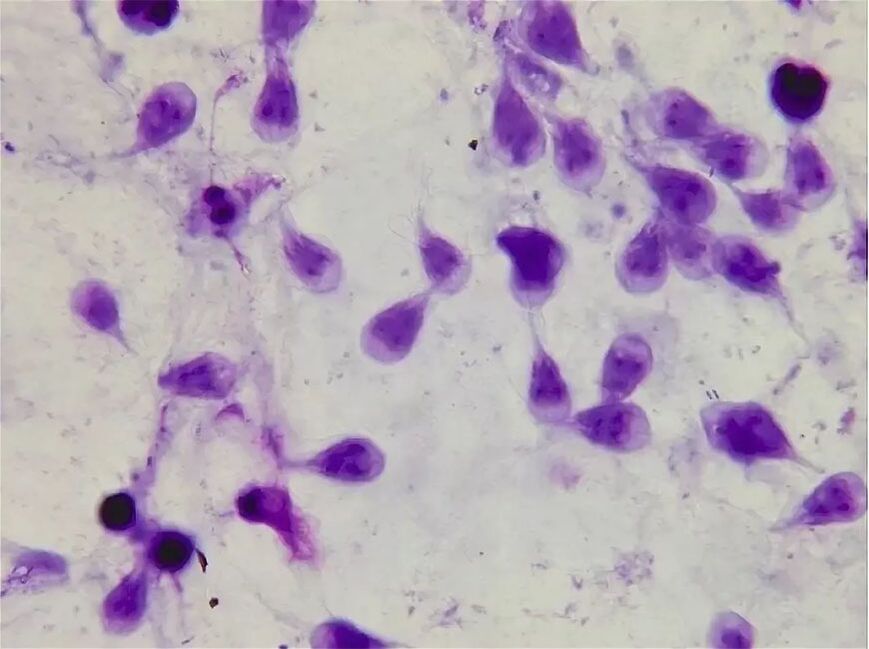 comment se débarrasser de la lamblia humaine